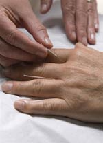 hand-acupuncture-needle